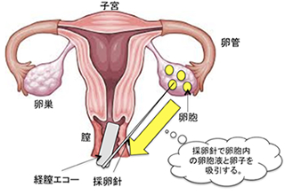 採卵