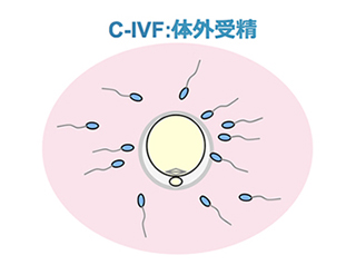体外受精