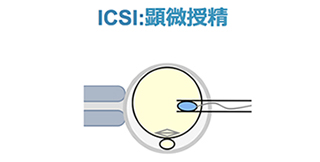 顕微受精